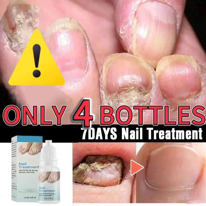 10ml Onychomycosis Reparatie Serumzalf Onychomycosis Paronychia Zorgcrème Nagel Teennagel Voetverzorging Reparatie Essence