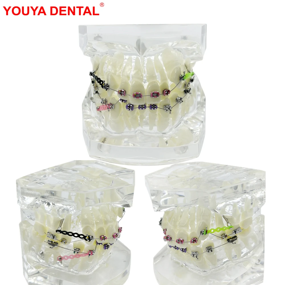Orthodontic Dental Model With Anchorage Nail Metal Bracket Ortho Teeth Model Transparent Typodont Jaw For Teaching Studying Demo