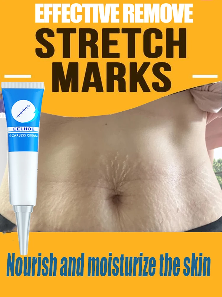 

Moisturize and Repair Removal Cream Pregnancy Stretch Marks Removal Effective Treatment Eliminate Red White Old Marks