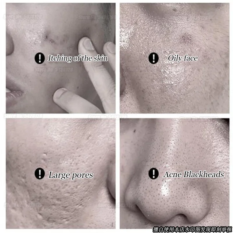 Limpeza Facial Especial Masculino, Remover Marcas De Acne, Encolher Poros, Controle De Óleo