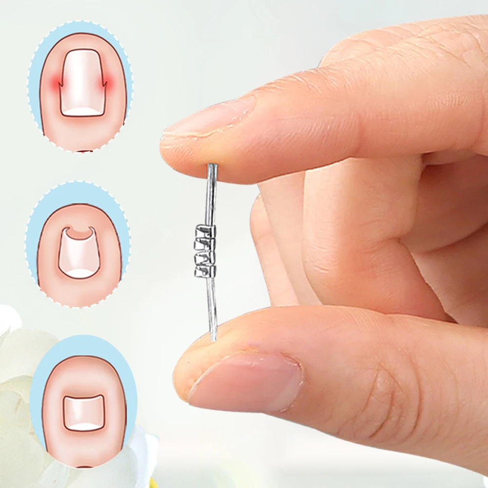 

Curved Clamp Toenails Correction Tool Ingrown Toenail Corrector Tool Ingrown Toenail Correction Foot Care Tool for Toes
