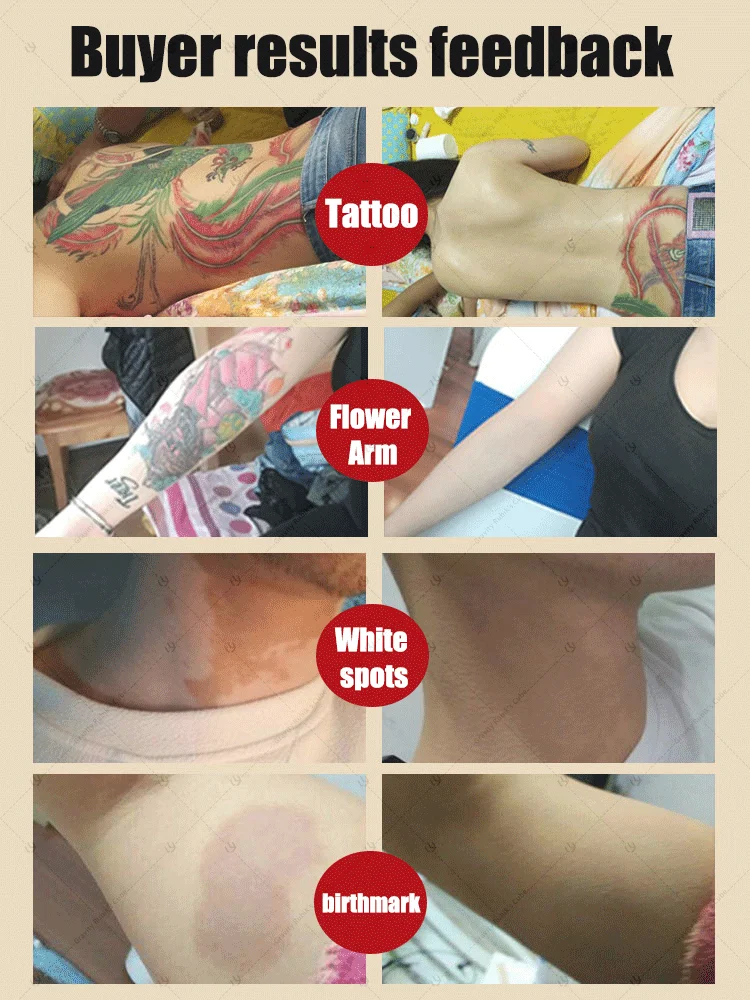 Il tatuaggio scompare e non può vedere