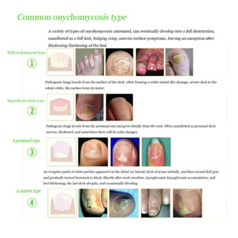 (HS) قطعة واحدة 10 مل للعناية بالبشرة الصحية وإصلاح الأظافر ومنظف سائل لإزالة فطار الأظافر