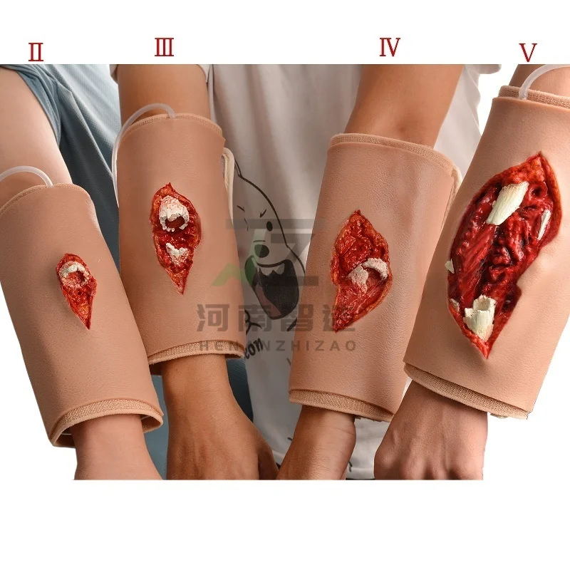 Orthopedic Teaching Model, Wearable Grade 1-4 Fracture Model, Models for Handling and Bandaging Fractures of Different Degrees