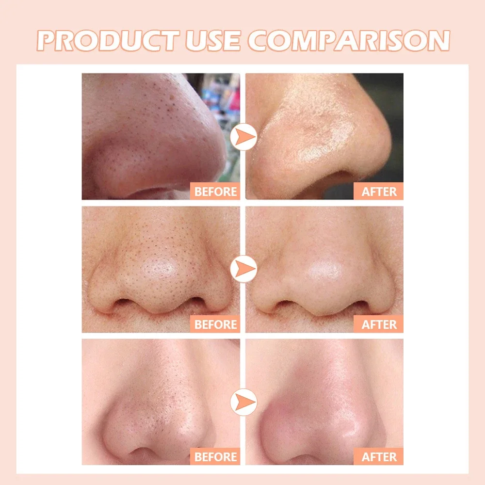 Blackhead Remover สิว Popper เครื่องมือเข็มสิวถอด Treatment Comedone Whitehead Popping Zit Nose Face Blemish EXTRACTOR