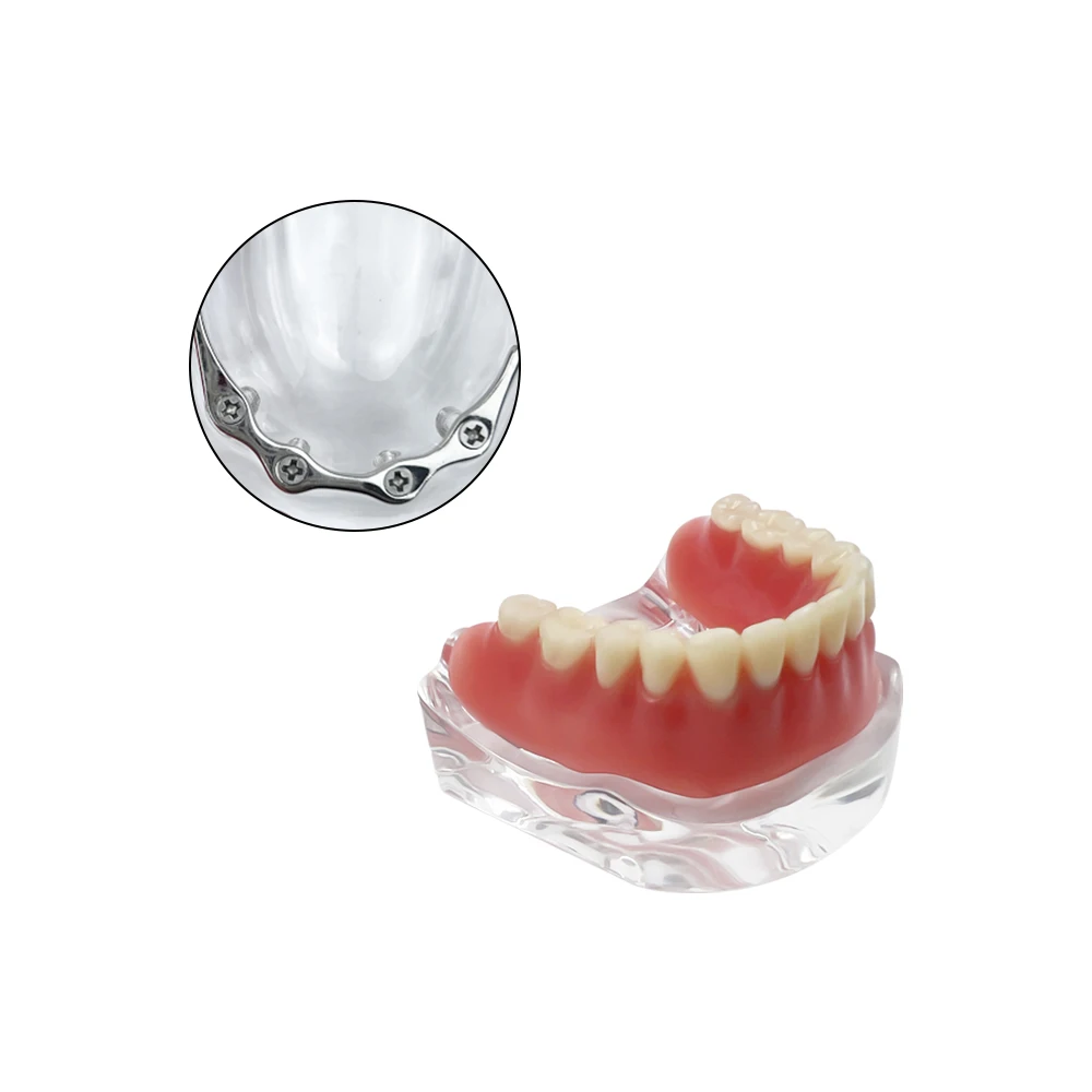 Zdejmowany model zębów Overdenture z 4-implantami dolnego mostu szczękowego Demo nauczania dla pacjentów dentystycznych Model złotego/srebrnego pręta