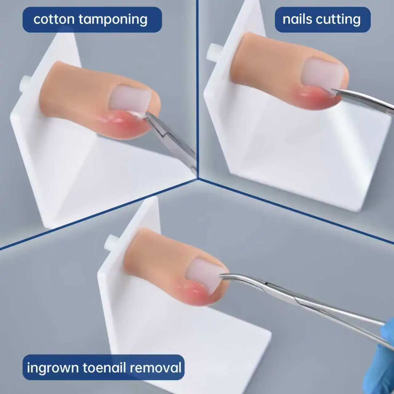 Ingrown Toenail Trainer with Replaceable Toes and Nails– Realistic Simulator for Medical Education & Wound Care Training