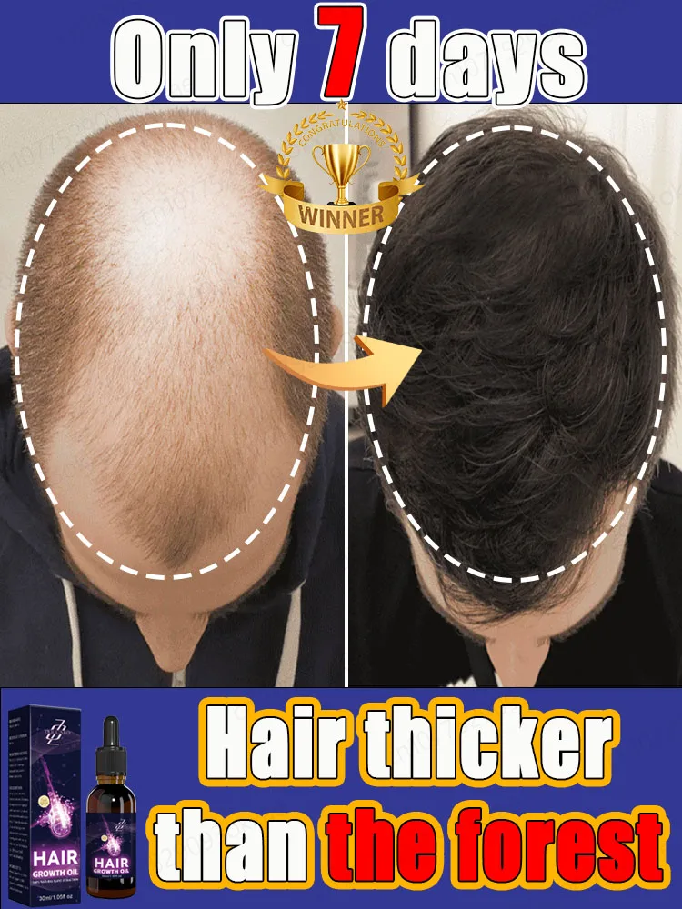 헤어 그로스 세럼, 두꺼운 머리카락 회복, 99%의 사람들이 재구매