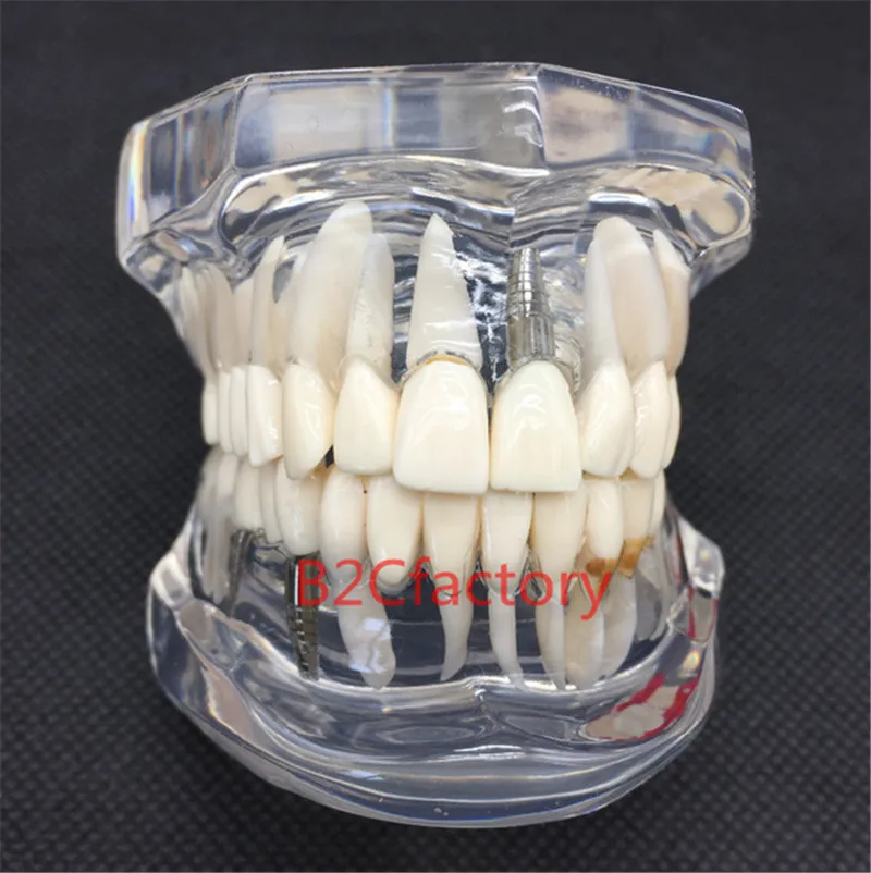 

6pcs/lot Dental Implant Disease Teeth Model With Restoration Bridge Tooth