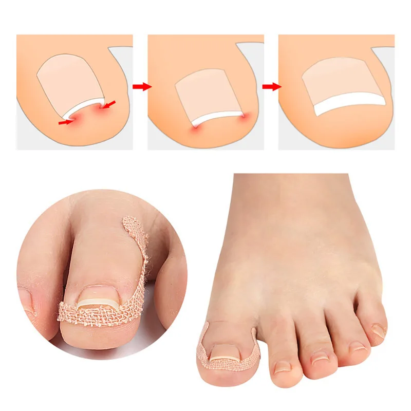 Improve Toe Embedded Nail Groove Relief Paste And Correct Nail Curling