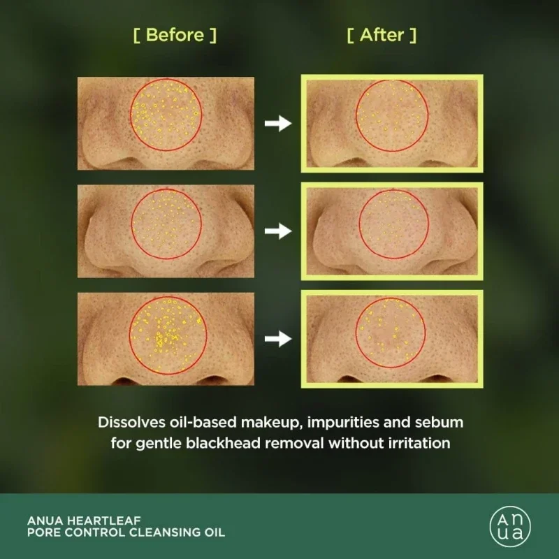 Démaquillant coréen Anua en feuille de cœur, huile nettoyante, contrôle des pores, rétrécissement, élimination rapide des points noirs, nettoyage de la peau, 200ml