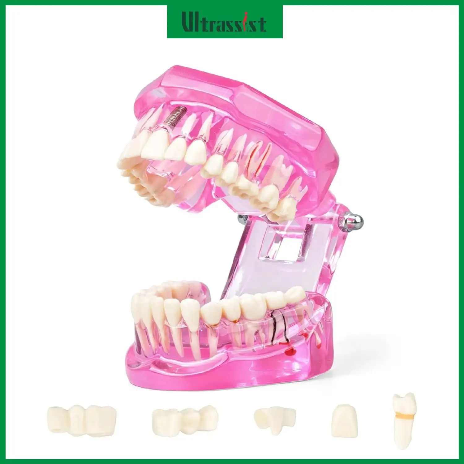 Ultrassist Transparent Disease Teeth Model Dental Implant Bridge Pathology Demonstration for Medical Dentist Patient Education