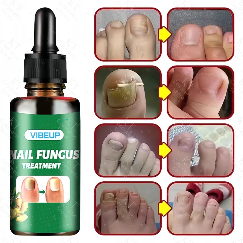 7 Days Nail Fungus Treatment Serum Ginger Anti-Infective Paronychia Onychomycosis Toe Foot Nail Fungal Repair Gel Hand Foot Care
