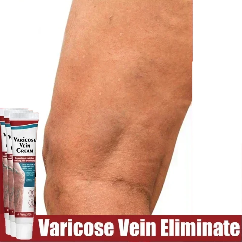 Varicose Veins Pen Improves Moderate Varicose Vein Laser Therapy Relieve Leg Pain Improve Blood Circulation for Men and Women