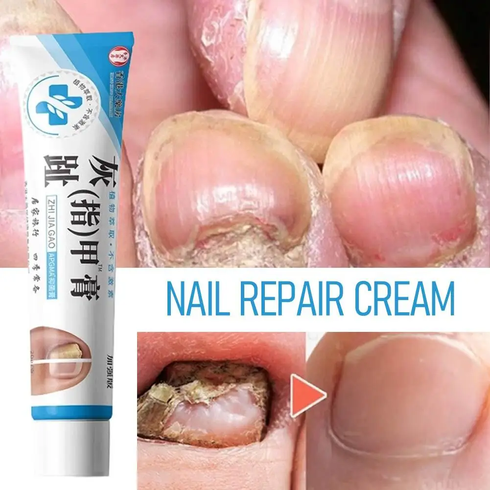 Plant Extract Hormone-Free Strengthened Onychomycosis Nail Care Cream, Gentle Effective Fungal Nail Treatment