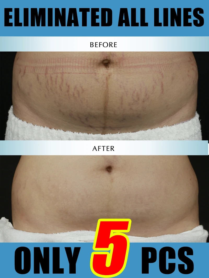 

Solving Belly Skin Problems