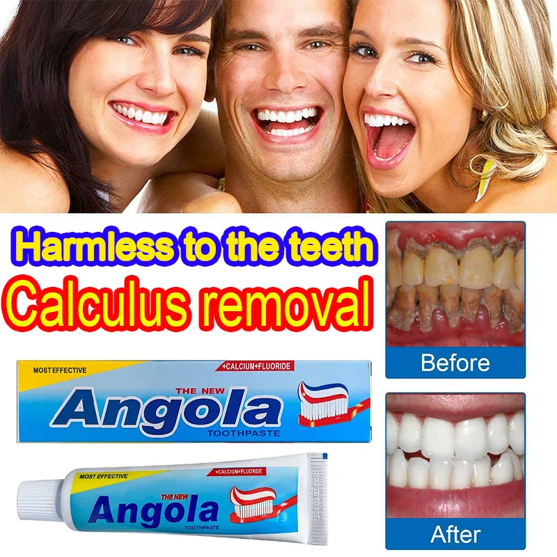 

Tartar Removal Dental Calculus Teeth Whitening