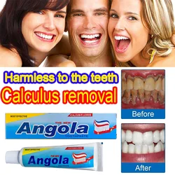 Tartar Removal Dental Calculus Teeth Whitening