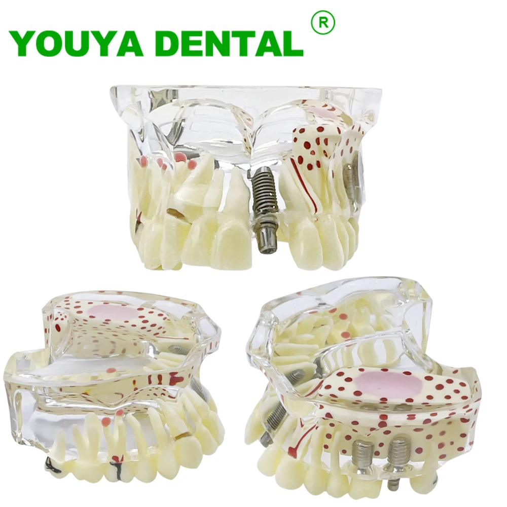 Dental Maxillary Implant Model Upper Jaw Teeth Restoration Model With Removable Tooth Demonstration Model For Practice Teaching