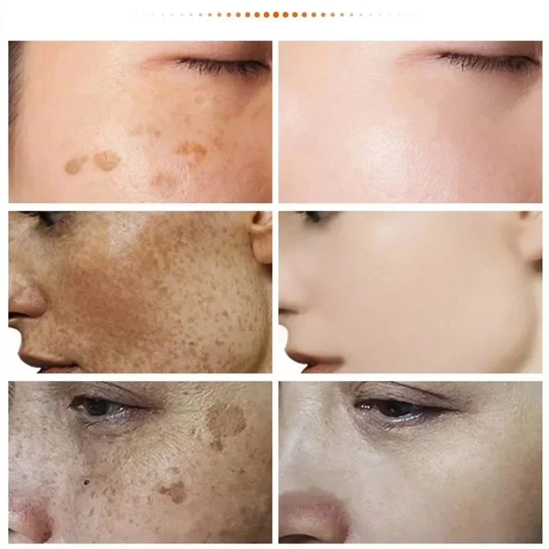 Lighten Melasma Frec&kles Face Dark Skin Brighten For Women Removal Melanin Whit&ening Fade Spo&ts Skin Care