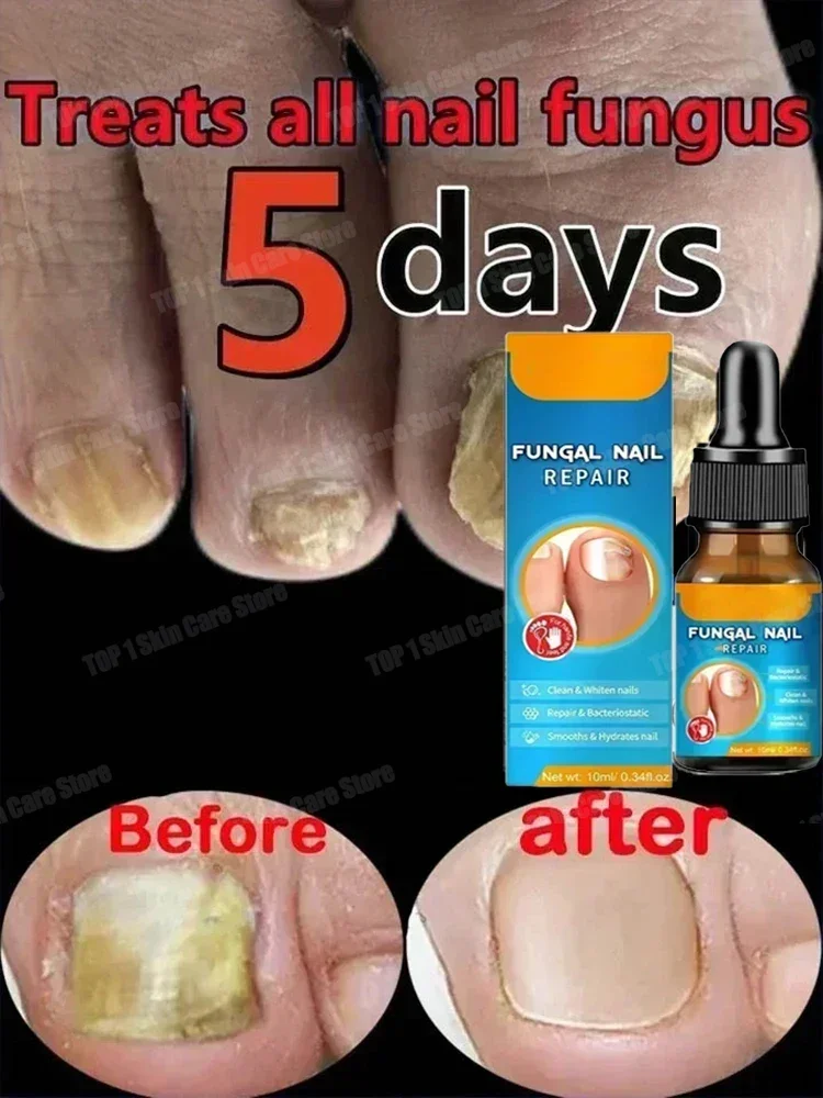 Fungal Nail Treatment คุด Toenail Repair เชื้อราเล็บ Treatment Liquid Anti Paronychia บรรเทาน้ํามันหยุดปวด