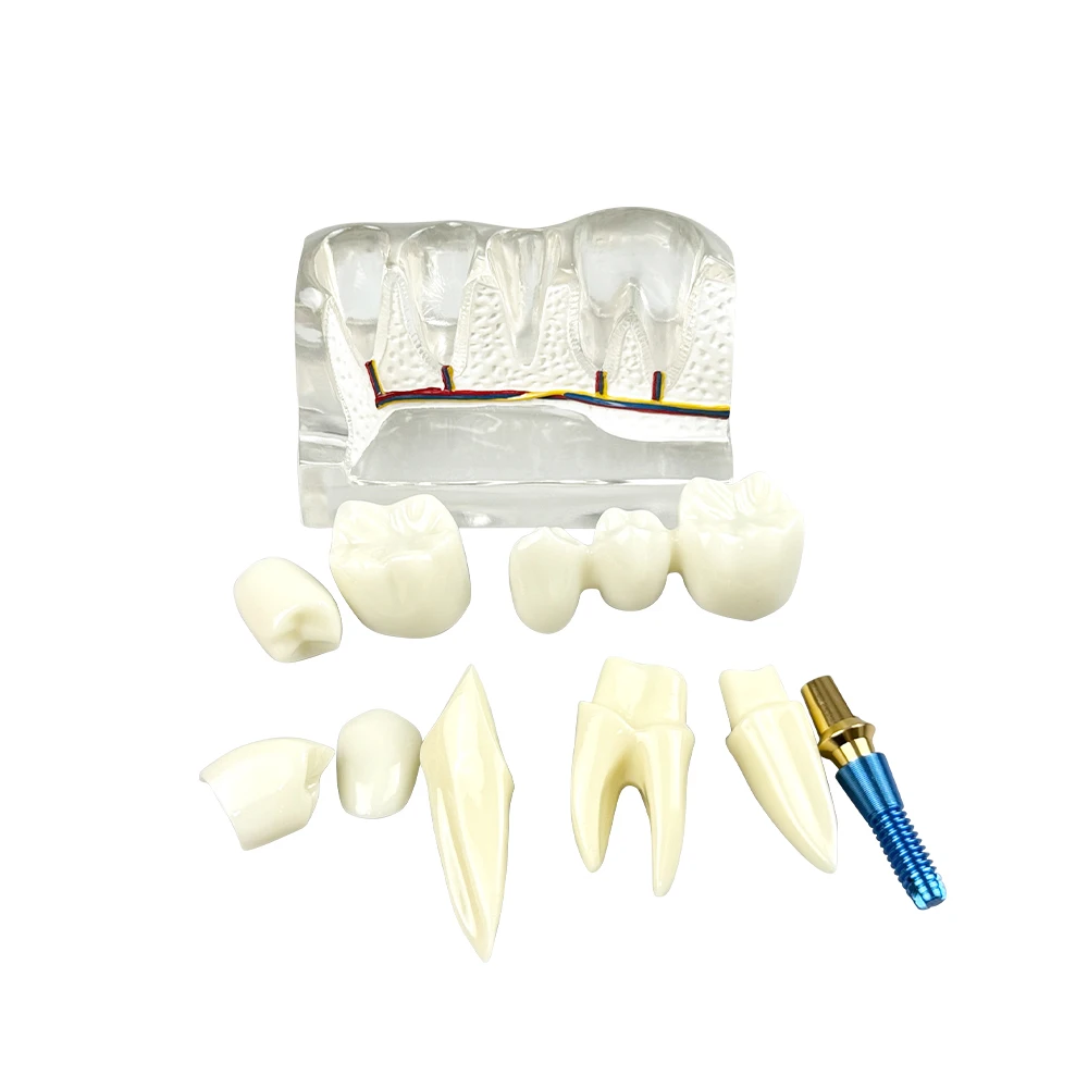 

4 Times Dental Implant Model Dental Analysis Removable Resin Dental Model Teaching Demonstration Research Model