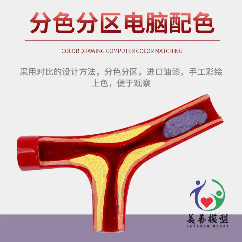 Simulation Dynamic Vascular Model Vascular Concentration Blockage Comparison Human Hyperlipidemic Plaque Thrombosis Teaching Mod