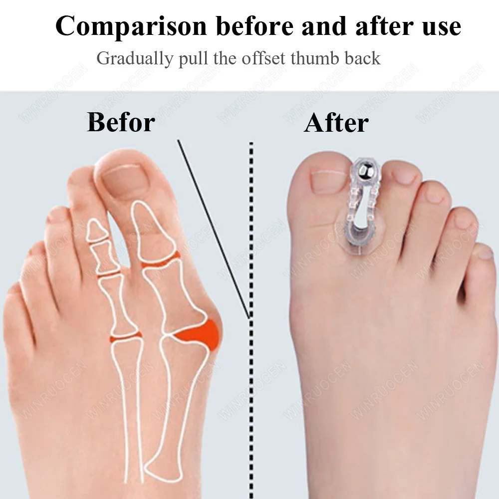 WINRUOCEN Magnet Kaki Ortopedi Pemisah Pemisah Jempol Kaki Besar Bunion Hallux Jempol Pelurus Jari Alat Perawatan Kaki