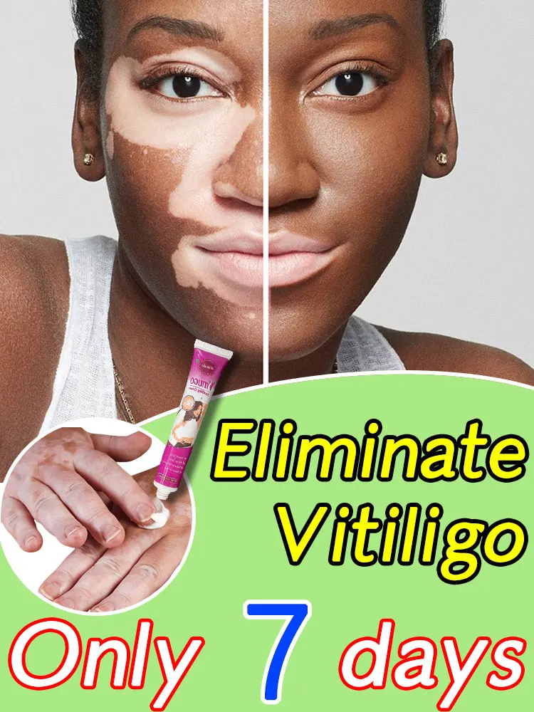 

Vitiligo Quickly Improves White Spots