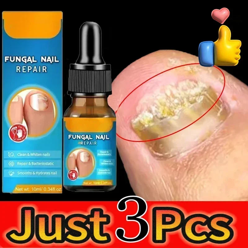 

Fast Fungal Nail Treatments Serum Onychomycosis Paronychia Anti-Fungal Anti-infective Herb Toe Fungus Foot Repair Essences Care