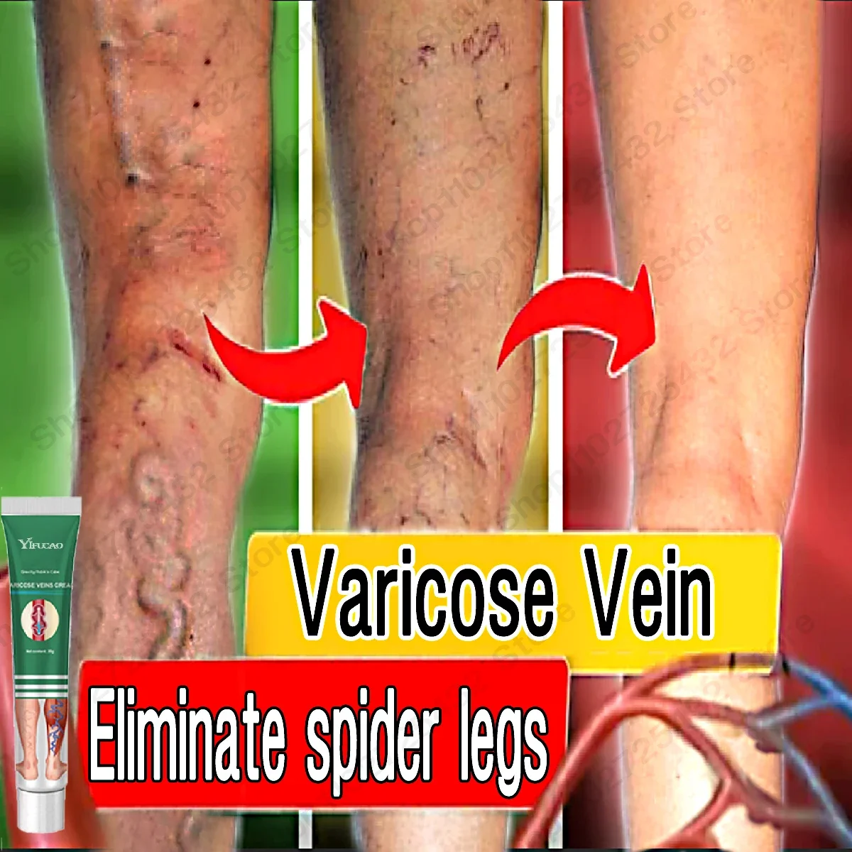 Creme eficaz do tratamento da veia varicosa, aliviar as pernas, vasculite dilatada, flebite, pomada fórmula natural