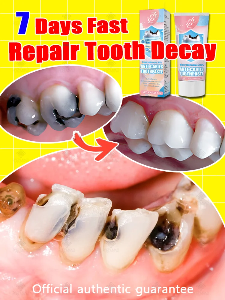 

Tooth decay repair