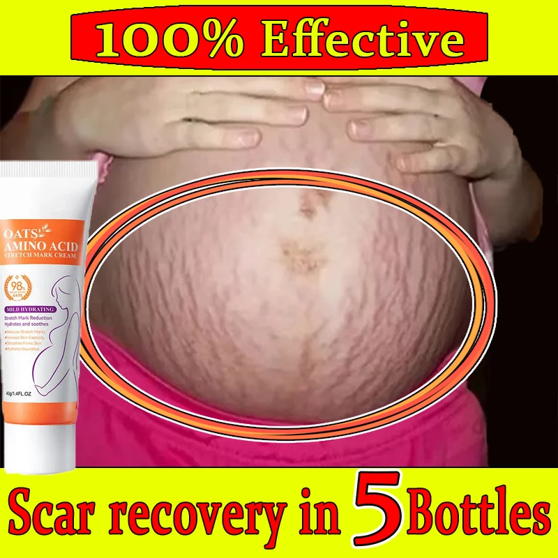 Scar Cream For Burns Acene C-Section Stretch Marks Keloids Removal Cream For Old And New Suitable For Women