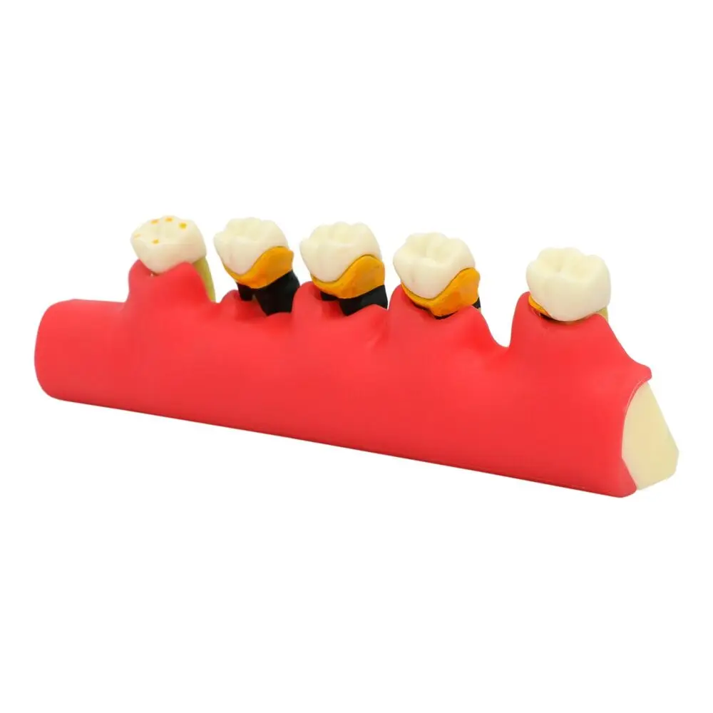 

Teeth Model Periodontal Disease Model Assort Demo 5 Stage three-Dimensional Proportional Magnification Design M4010
