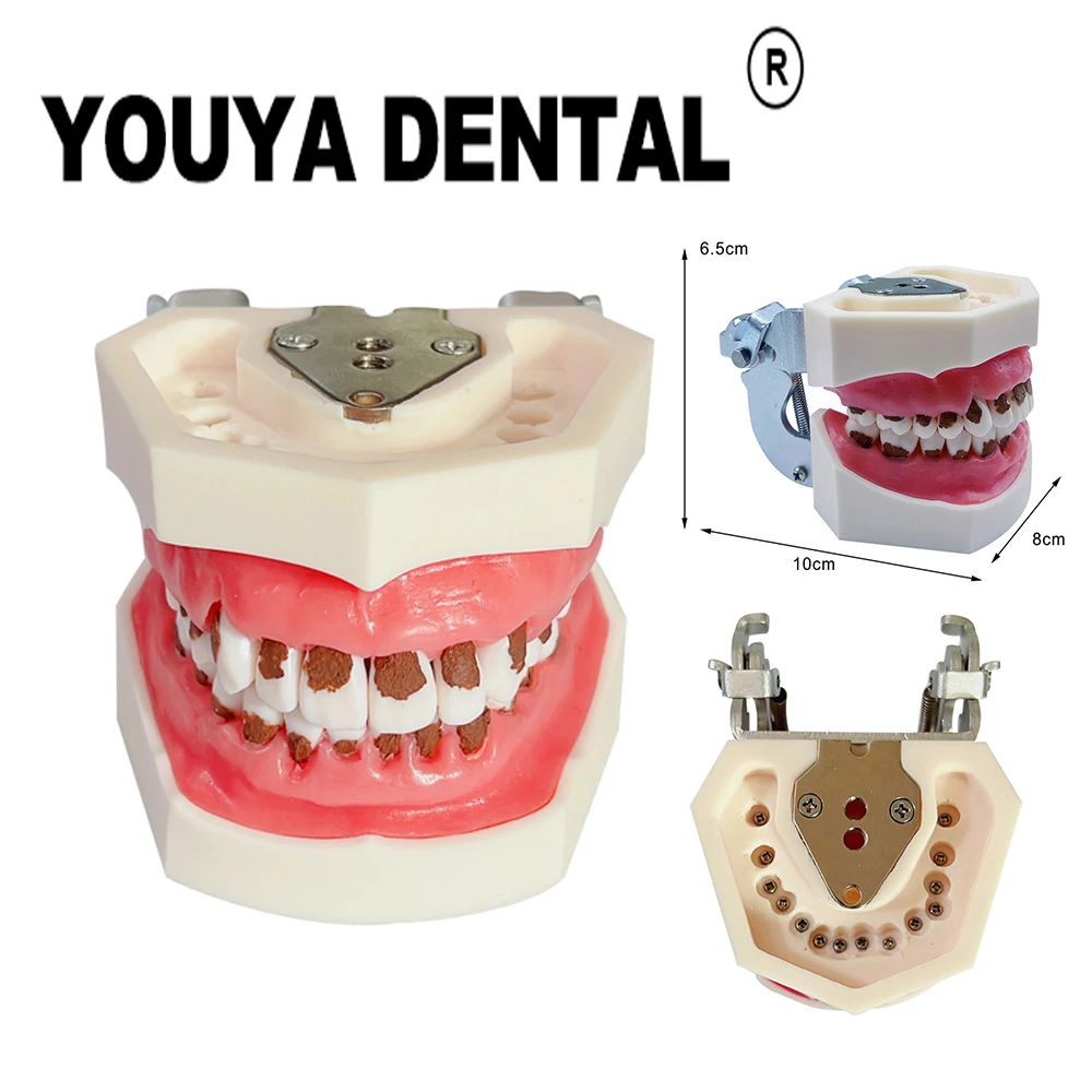 Dental Calculus Model Cleaning Treatment Simulation Training Model Practice Pathological Observation And Explanation Teaching