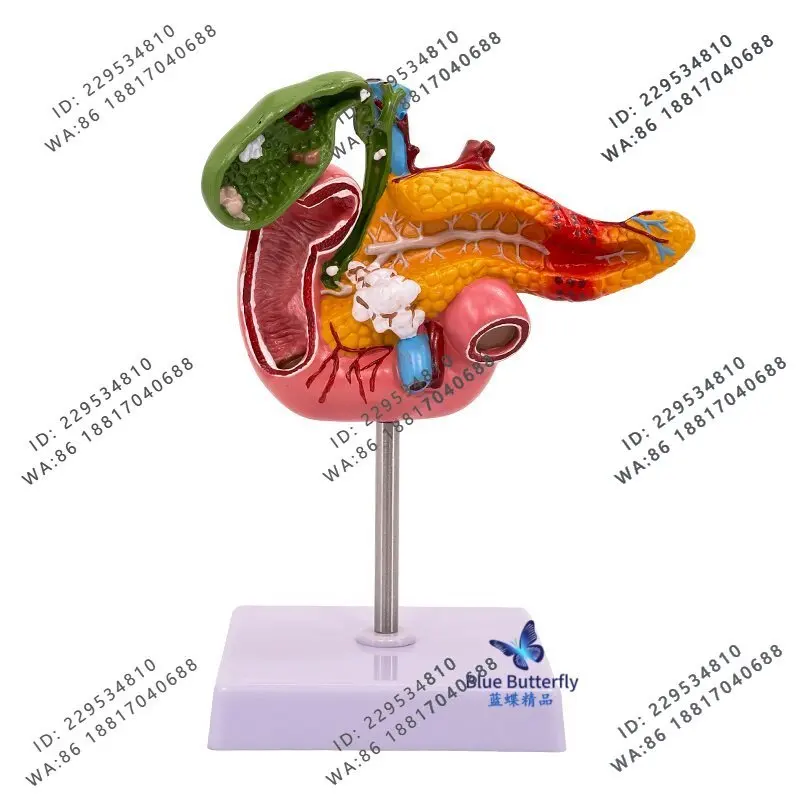 Medical pancreas duodenal gallbladder pathological model, hepatobiliary model