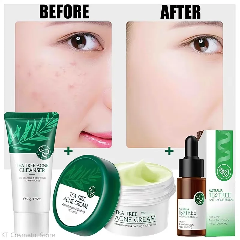 Set de Cuidado Facial de Belleza con Extracto de Plantas: Sérum de Árbol de Té 17ml, Crema Antiacné 20g, Limpiador 50g, Refrescante, Hidratante y Humectante