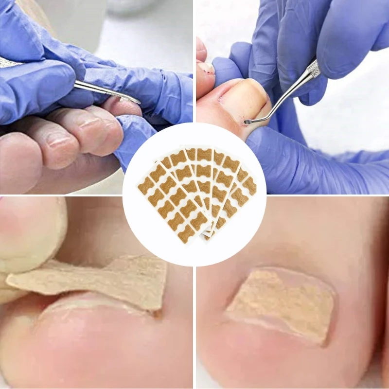 Les patchs correcteurs d'ongles incarnés le tampon remplissage éliminent les ongles ennuyeux, livraison directe