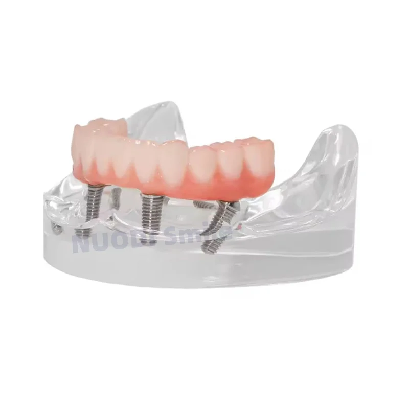 Dental Implant Lower Jaw Restoration Teeth Model All-on-4 Overdenture Model 4 Screws with Post Core Bridge Dentistry Study Model