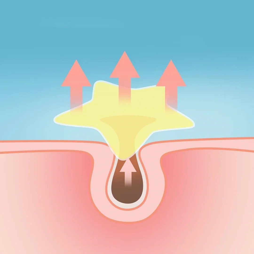 Hurtowe plastry na pryszcze Star Acne, 240 sztuk, kolorowe, cienkie, oddychające, kompatybilne z makijażem, zakrywające niedoskonałości.