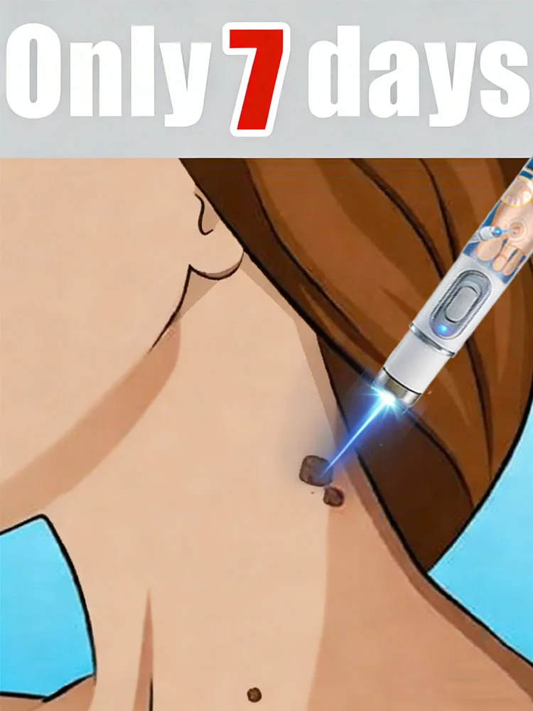 

Недавно модернизированный лазер второго поколения способен устранить все бородавки за 7 дней.