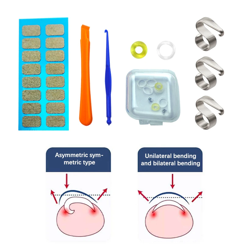 내성발톱 교정 도구, 전문 내성발톱 교정, 발 페디큐어 케어 도구, 매립 복구 발톱 치료