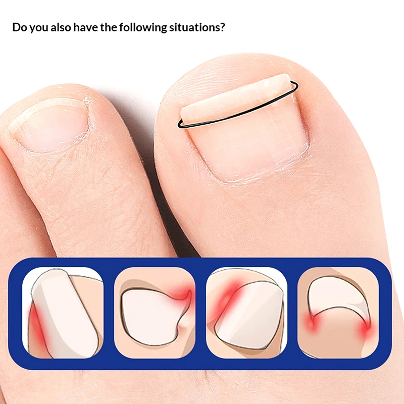 2Pcs Ingrown Toenai…