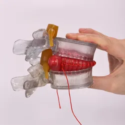 Enlarged human spine and lumbar spine pathology Model demonstration model of lumbar disc herniation Model
