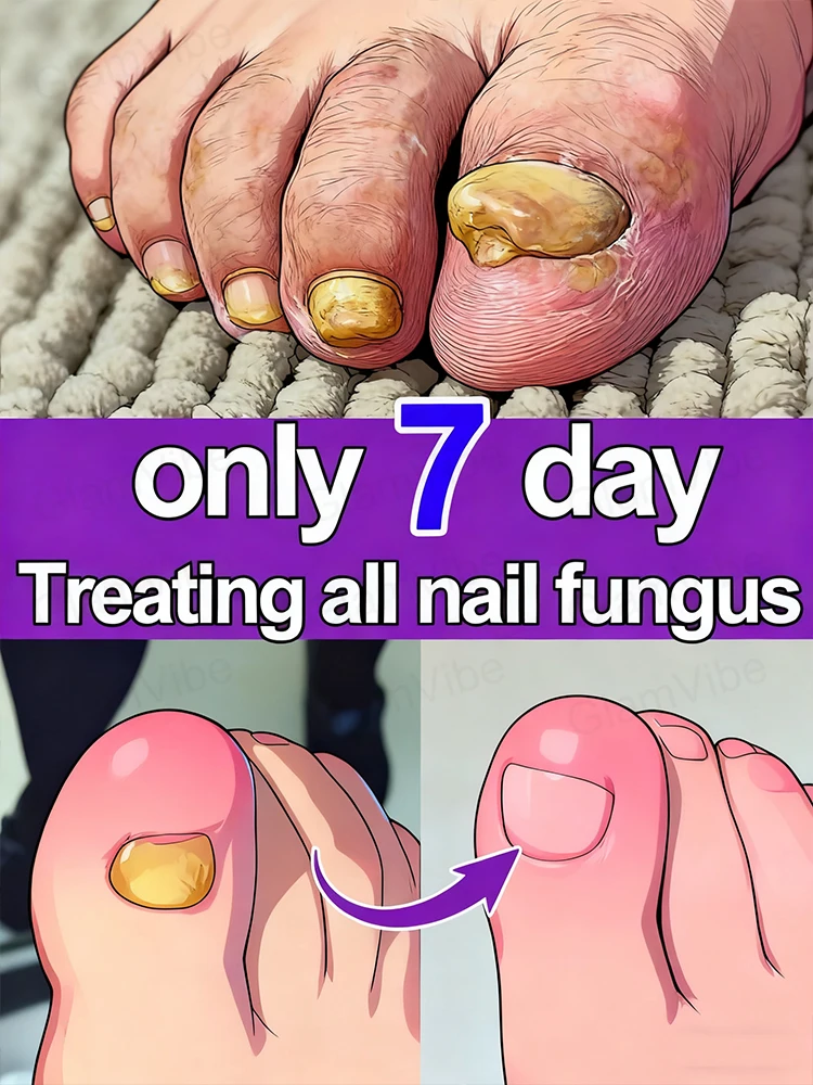 

Tʀᴇᴀᴛ ᴏɴʏᴄʜᴏᴍʏᴄᴏsɪs ᴀᴛ ʜᴏᴍᴇ! Yᴏᴜʀ ɴᴀɪʟs ᴡɪʟʟ ɢᴇᴛ ʙᴇᴛᴛᴇʀ ᴅᴀʏ ʙʏ ᴅᴀʏ.