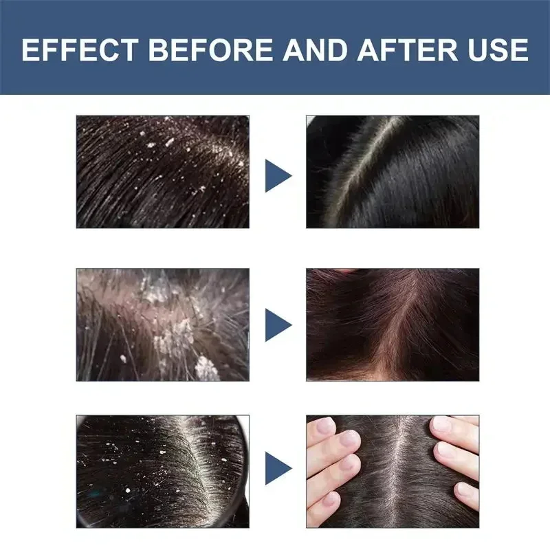 علاج فروة الرأس جوهر رذاذ القشرة الحكة السيطرة على النفط مكافحة فقدان فروة الرأس تنظيف إصلاح مصل منتجات العناية بالشعر الجمال