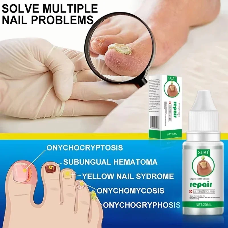 Foot Essence Liquid Treatment Paronychia Hand Feet Removal Repair Anti Infection Foot Care Grey Nail Repair Liquid Fungu