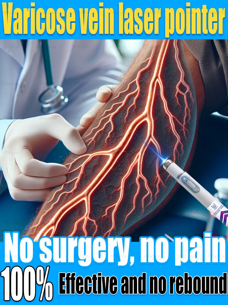 Tʜɪʀᴅ ɢᴇɴᴇʀᴀᴛɪᴏɴ ᴠᴀʀɪᴄᴏsᴇ ᴠᴇɪɴ ʟᴀsᴇʀ ᴇʟɪᴍɪɴᴀᴛᴇs ᴠᴀsᴄᴜʟɪᴛɪs ᴀɴᴅ ᴘʜʟᴇʙɪᴛɪs, ʀᴇʟɪᴇᴠᴇs sᴘɪᴅᴇʀ ʟᴇɢ ᴘᴀɪɴ, ʟᴀsᴇʀ ᴘᴏɪɴᴛᴇʀ ᴛʜᴇʀᴀᴘʏ