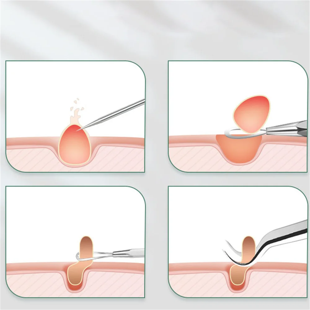 Agulhas De Remoção De Cravo De Aço Inoxidável, Kit Removedor De Acne, Black Dots Cleaner Tool, Agulha De Espinhas De Salão De Beleza