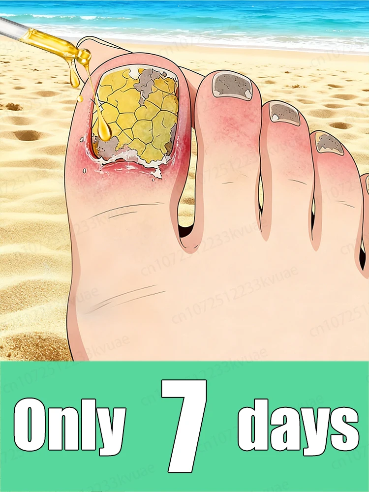 

Get rid of onychomycosis in just 7 days.